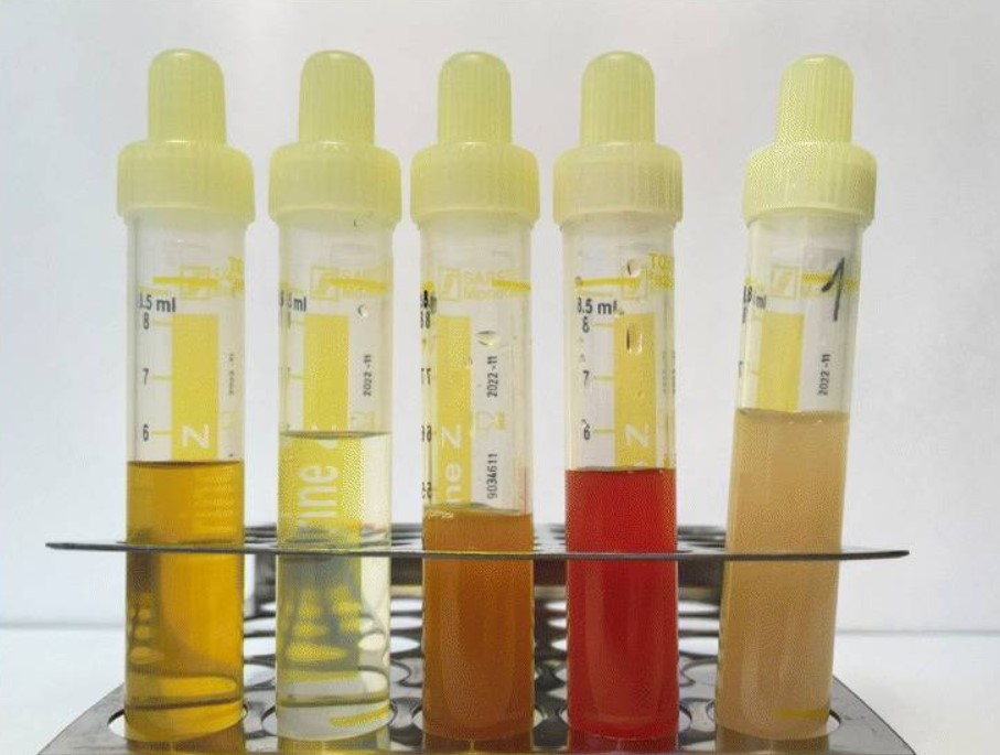 Social sharing card for North Tees trial tests five-minute urine check for acute pancreatitis